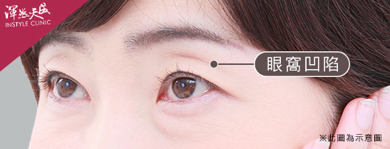 渾然天成整形醫美-眼窩凹陷：上眼皮有明顯向內凹陷的皺褶，更嚴重則有多層皺褶，也是老化的象徵。