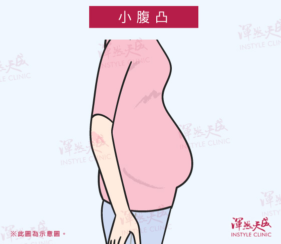 小腹凸|渾然天成整形醫美 小腹凸|渾然天成整形醫美