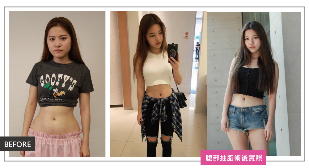渾然天成整形醫美|腹部三合一術前、術後。 渾然天成整形醫美|腹部三合一術前、術後。