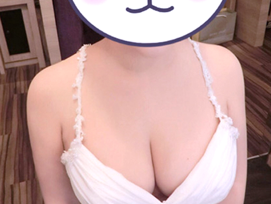 渾然天成整形醫美|術後約一個月-看不見副乳,效果很滿意。 渾然天成整形醫美|術後約一個月-看不見副乳,效果很滿意。