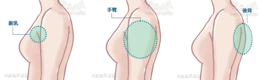 渾然天成整形醫美|手臂三合一抽脂「副乳+手臂+後背」三部位脂肪一次解決。 渾然天成整形醫美|手臂三合一抽脂「副乳+手臂+後背」三部位脂肪一次解決。