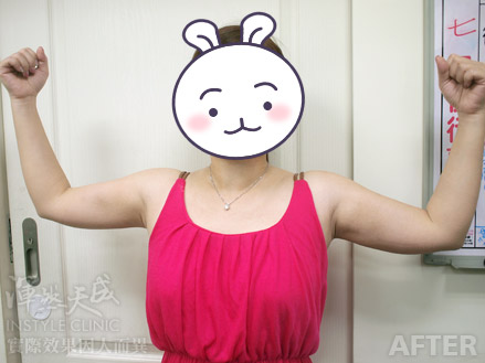 渾然天成整形醫美|術後第5天左右,腫脹感舒緩很多。 渾然天成整形醫美|術後第5天左右,腫脹感舒緩很多。