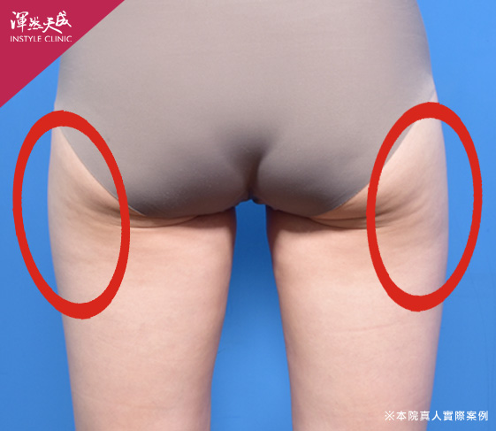 渾然天成整形醫美|大腿抽脂三合一-馬鞍 渾然天成整形醫美|大腿抽脂三合一-馬鞍