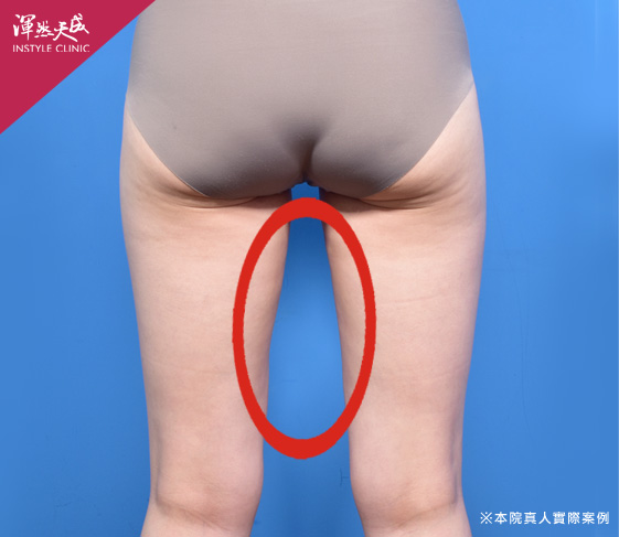 渾然天成整形醫美|大腿抽脂三合一-大腿內側 渾然天成整形醫美|大腿抽脂三合一-大腿內側
