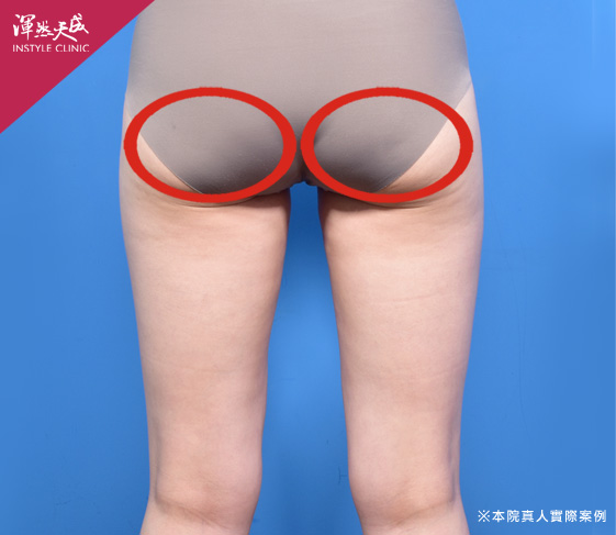 渾然天成整形醫美|大腿抽脂三合一-臀部 渾然天成整形醫美|大腿抽脂三合一-臀部