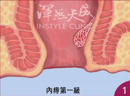 內痔一級 內痔一級示意圖