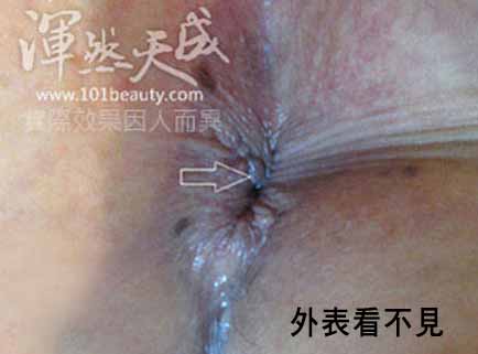 內痔一級肛門口看不出來 內痔一級肛門口示意圖
