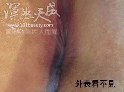 內痔一級肛門外觀看不出來 內痔一級肛門外觀示意圖