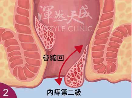 內痔二級 內痔二級示意圖