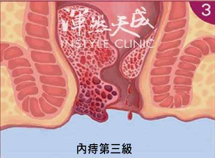 內痔三級 內痔三級示意圖