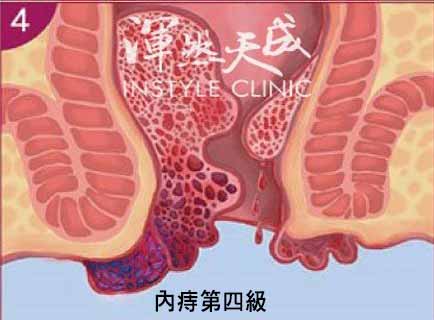內痔四級 內痔四級示意圖