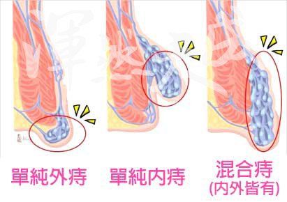 外痔、內痔、混合痔位置 單純外痔、內痔、混合痔位置圖