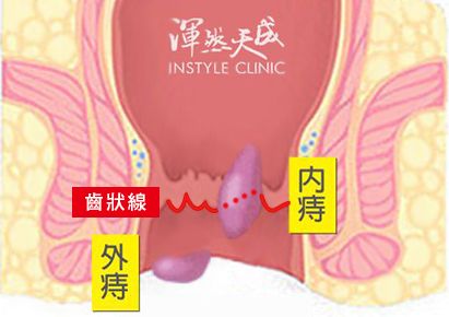 內痔、外痔,以齒狀線為界線 內痔外痔位置圖:以齒狀線為界線