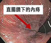 肛門直腸鏡下的內痔 肛門內視鏡檢查內痔狀況的照片