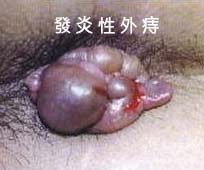 發炎性外庤 發炎性外庤示意圖