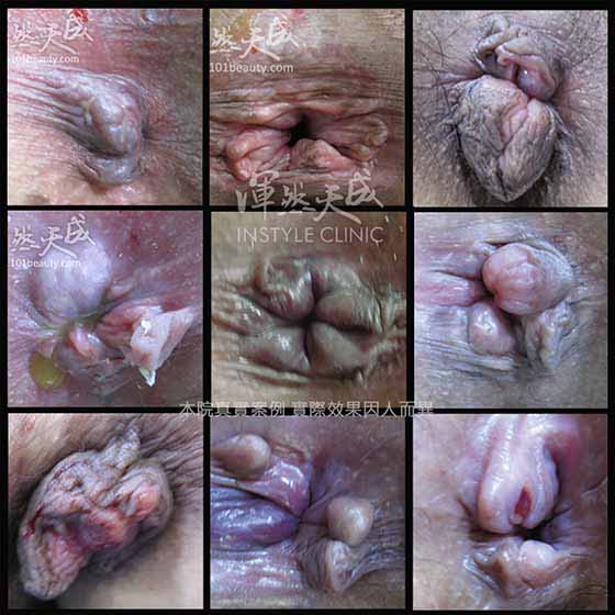 各種痔瘡型態的圖片 各種痔瘡型態的圖片