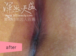 手術後傷口恢復緊緻 痔瘡手術後傷口恢復緊緻的模樣
