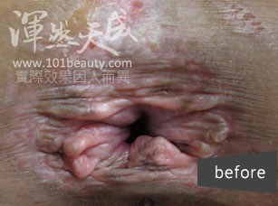 手術前痔瘡脫垂、肛門變形 手術前痔瘡脫垂而肛門變形,造成反覆濕疹