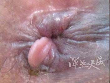 外觀看似一點點內外混合痔 乍看只有一點點內外混合痔