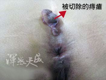 手術切除大痔瘡後的照片 手術切除大痔瘡後的照片,小菊花還原了
