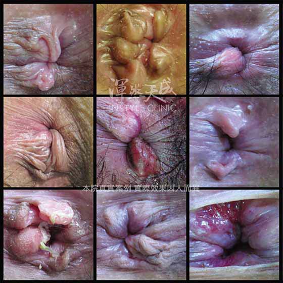 各式各樣的痔瘡照片 各式各樣嚴重的痔瘡照片