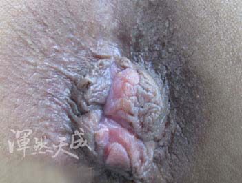 混合痔 內外混合痔