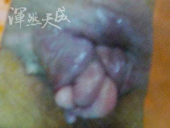 一用力就有大型內痔脫出肛門外 排便一用力時,大型的內痔脫出肛門外