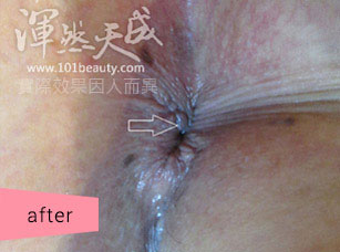 手術後傷口恢復緊緻 痔瘡手術後傷口恢復緊緻的模樣
