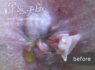 手術前嚴重的痔瘡 嚴重的痔瘡,肛門閉合困難,難清潔容易感染腫脹