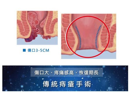 傳統痔瘡手術傷口大、疼痛大、恢復期長 比較傳統痔瘡與微創痔瘡手術,傳統痔瘡手術傷口大、疼痛大、恢復期長