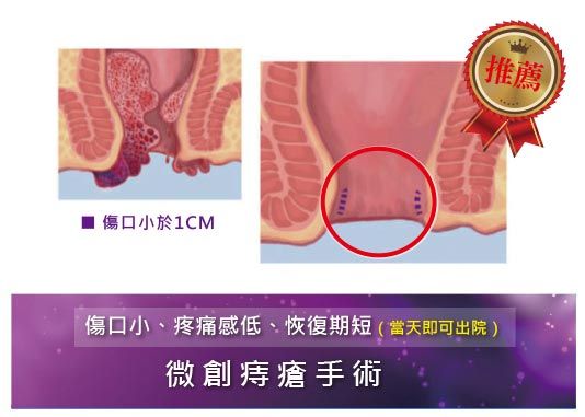 微創痔瘡手術傷口小、疼痛低、恢復期短、免住院 比較傳統痔瘡與微創痔瘡手術,微創痔瘡手術傷口小、疼痛低、恢復期短、不用住院