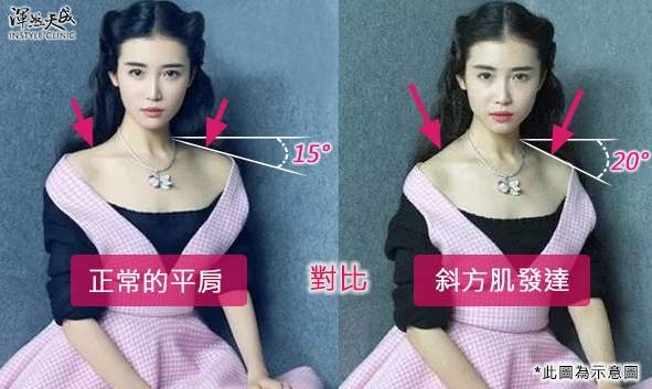 小於15度比較正常的平肩 小於15度比較正常的平肩
