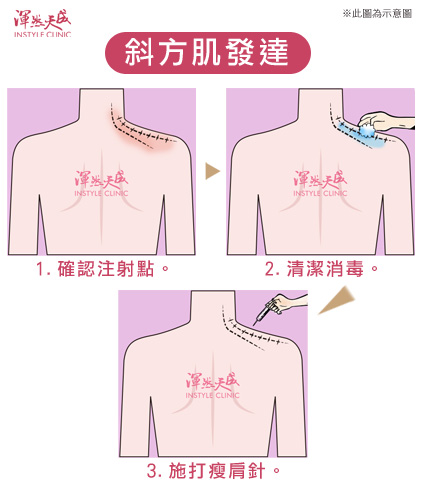 渾然天成瘦肩針施打方式|渾然天成整形醫美 渾然天成瘦肩針施打方式|渾然天成整形醫美。
