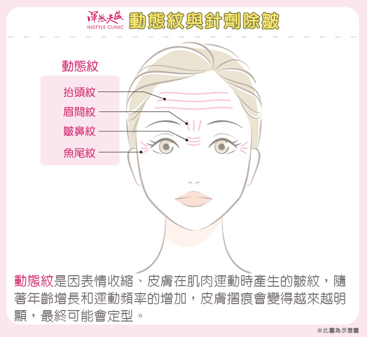 渾然天成整形醫美|動態紋 渾然天成整形醫美|動態紋