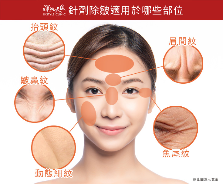 渾然天成整形醫美|針劑除皺適用於哪些部位? 渾然天成整形醫美|針劑除皺適用於哪些部位?