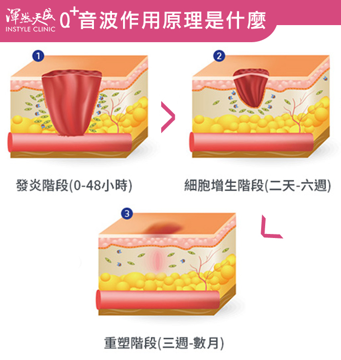 渾然天成整形醫美|作用原理。