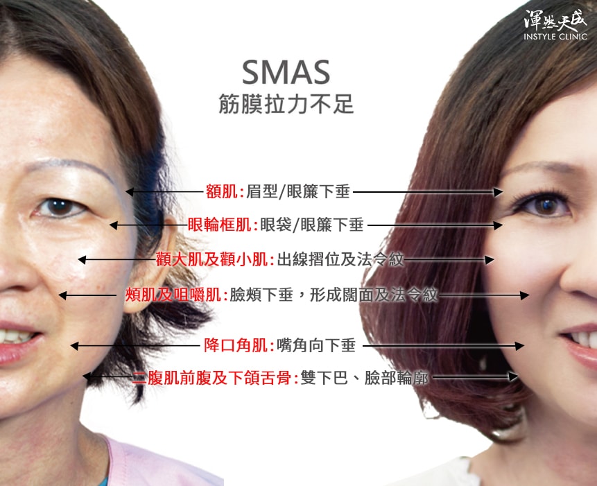 電音雙波同時改善筋膜拉力不足 電音雙波同時改善筋膜拉力不足