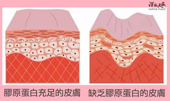 膠原蛋白充足的皮膚、缺乏膠原蛋白的皮膚,兩者對比 膠原蛋白充足的皮膚、缺乏膠原蛋白的皮膚,兩者對比