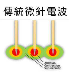 渾然天成整形醫美|傳統微針電波 渾然天成整形醫美|傳統微針電波