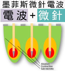 渾然天成整形醫美|墨菲斯微針電波 渾然天成整形醫美|墨菲斯微針電波