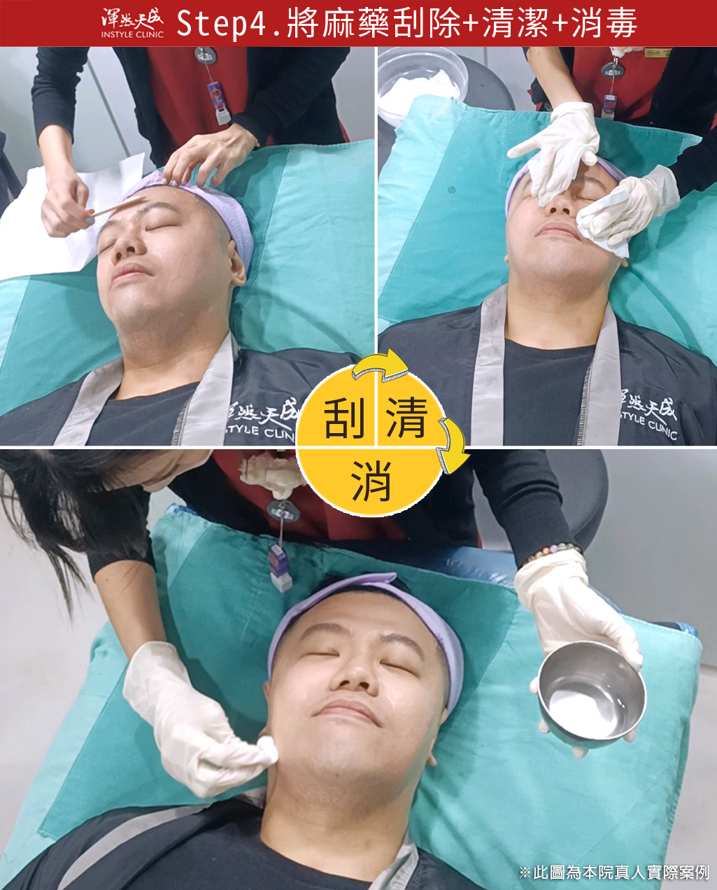 渾然天成整形醫美|墨菲斯微針電波-將麻藥刮除+清潔+消毒 渾然天成整形醫美|墨菲斯微針電波-將麻藥刮除+清潔+消毒
