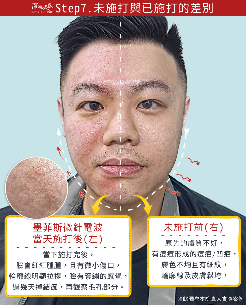 渾然天成整形醫美|墨菲斯微針電波-未施打與已施打的差別 渾然天成整形醫美|墨菲斯微針電波-未施打與已施打的差別