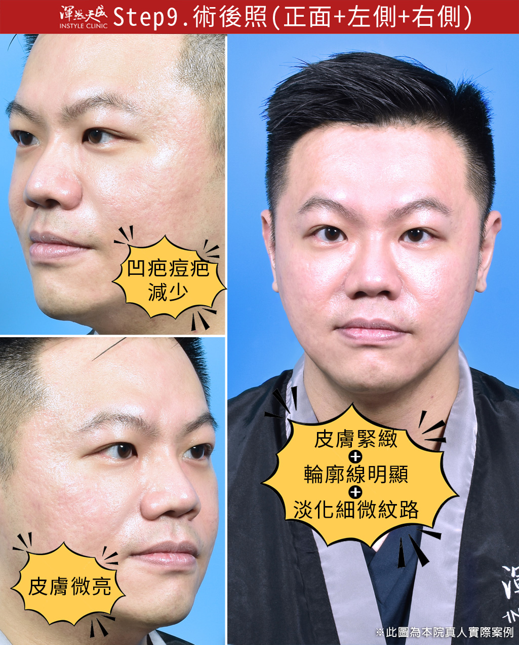 渾然天成整形醫美|墨菲斯微針電波-術後照(正面/左側/右側) 渾然天成整形醫美|墨菲斯微針電波-術後照(正面/左側/右側)