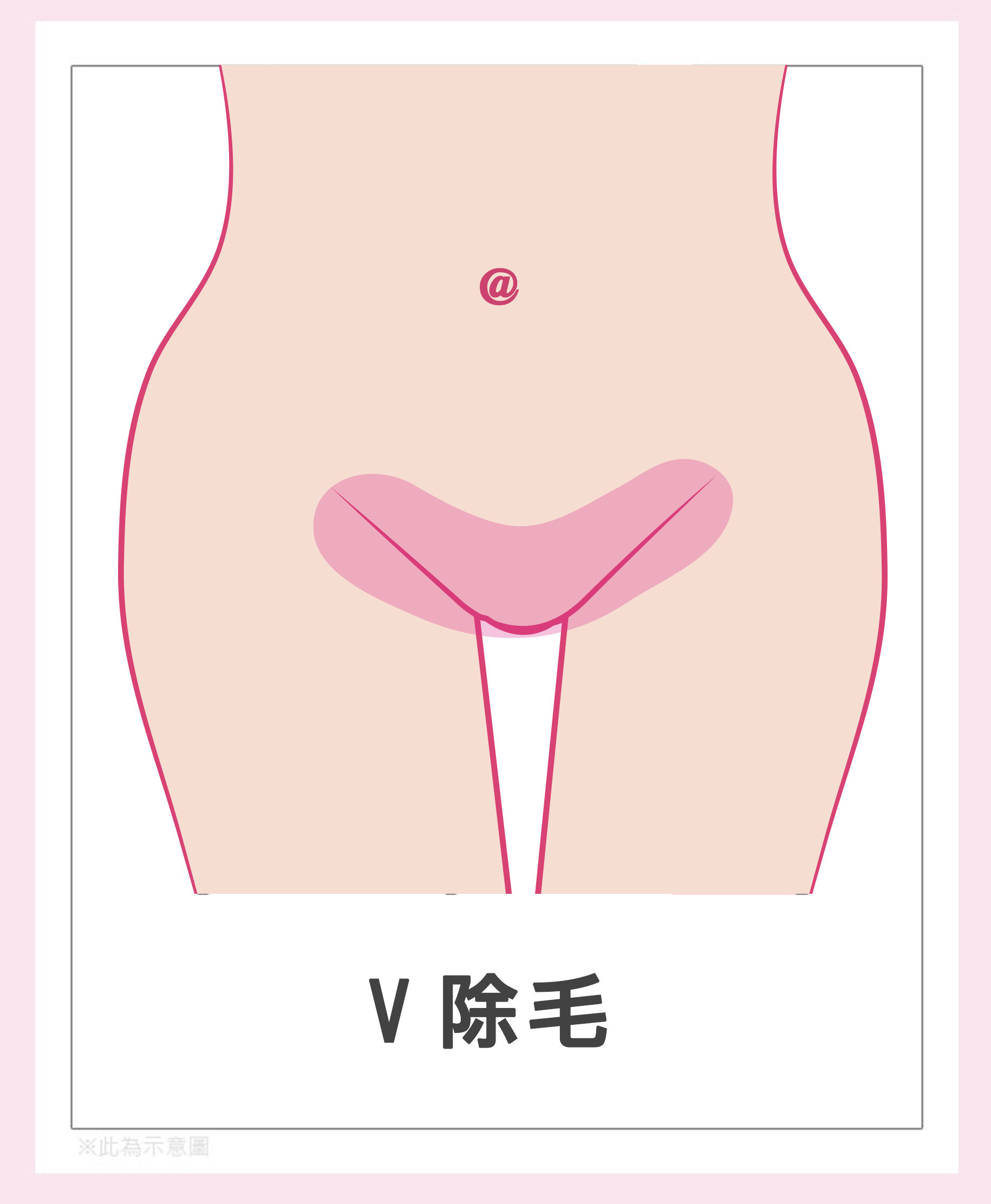 女性私密處除毛-V(陰阜)除毛。|渾然天成整形醫美 女性私密處除毛-V(陰阜)除毛|渾然天成整形醫美
