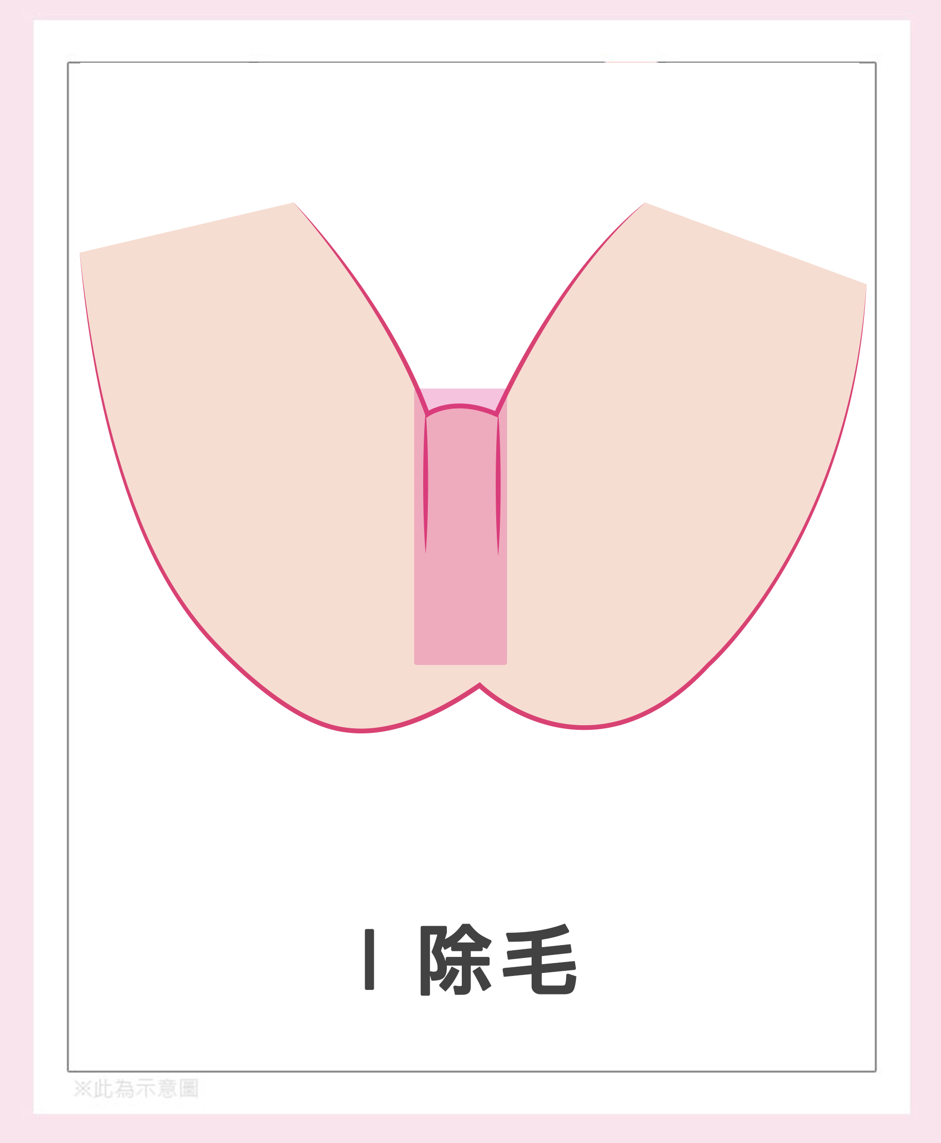 女性私密處除毛-I(大陰唇)除毛。|渾然天成整形醫美 女性私密處除毛-I(大陰唇)除毛。|渾然天成整形醫美