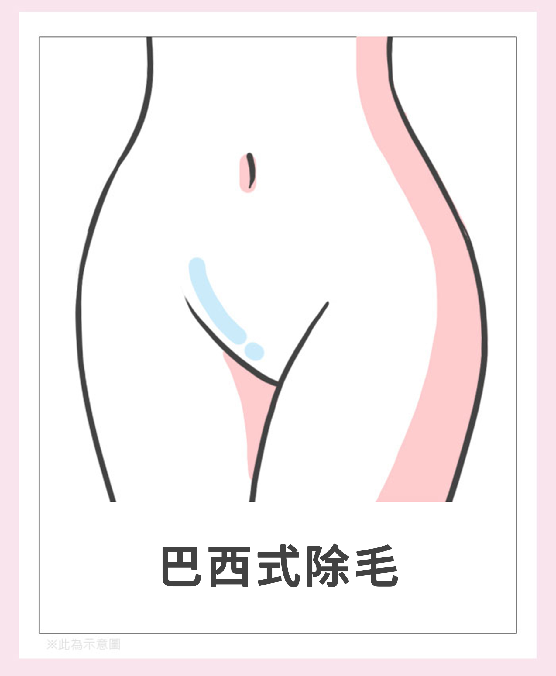 女性私密處除毛-VIO全除(巴西式除毛)。|渾然天成整形醫美 女性私密處除毛-VIO全除(巴西式除毛)。|渾然天成整形醫美
