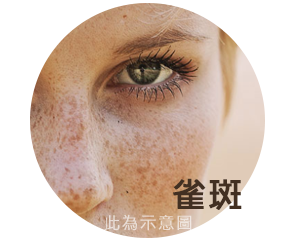 渾然天成,雷射除斑