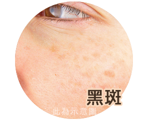 渾然天成,雷射除斑