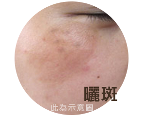 渾然天成,雷射除斑