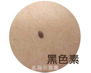 渾然天成,雷射除斑